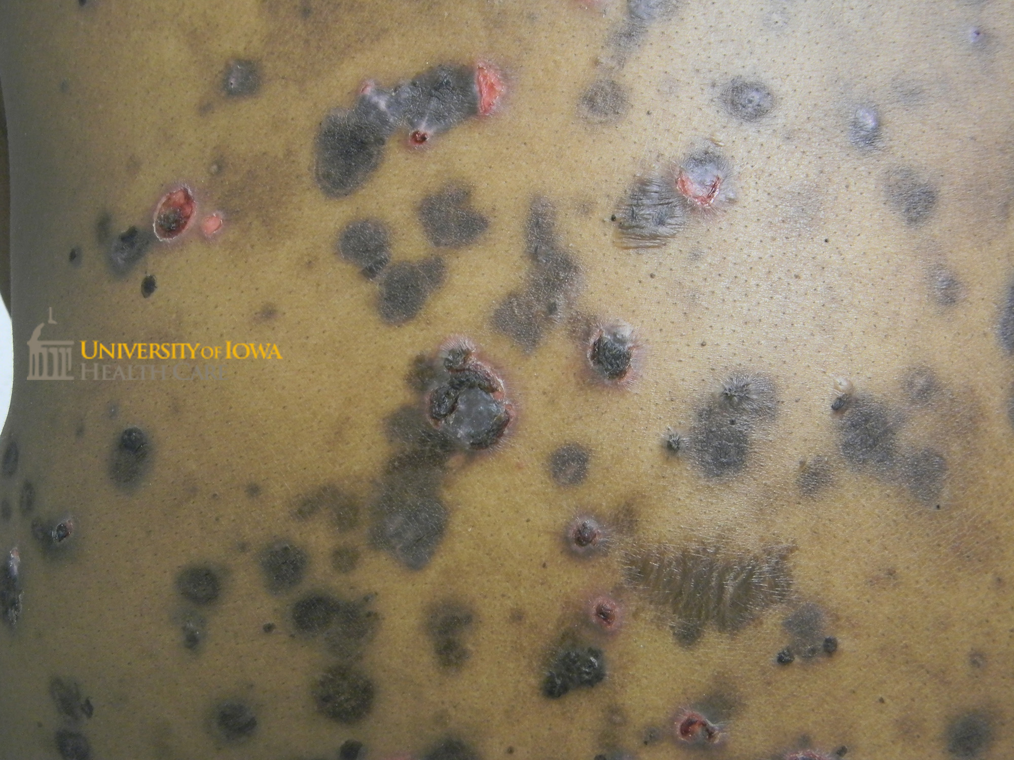 Scattered erosions with hemorrhagic crust and many circular hyperpigmented macules and patches. (click images for higher resolution).